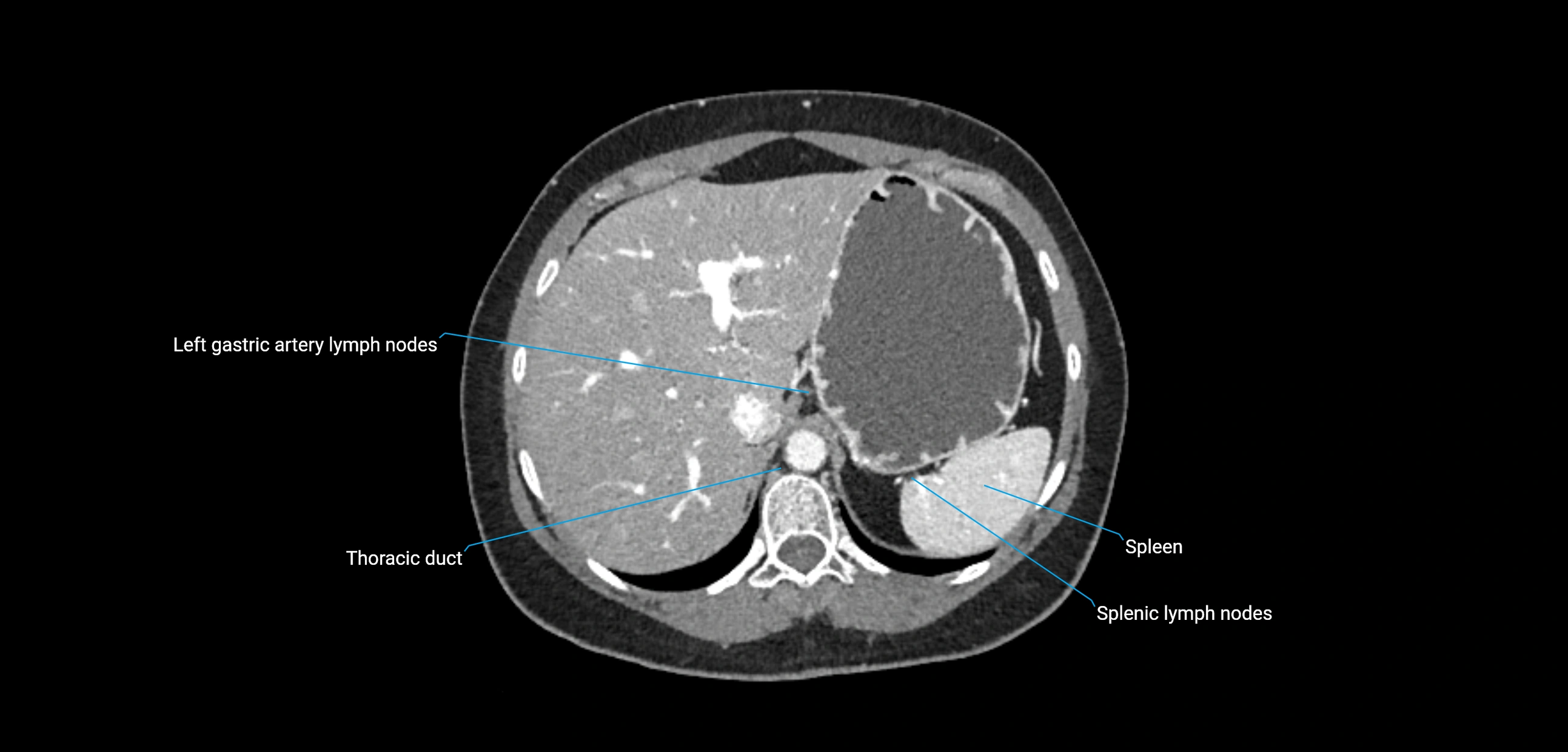 CT ct abdominal lymph nodes  axial cross sectional anatomy  enchanced radiology image -img-00002-00114.webp